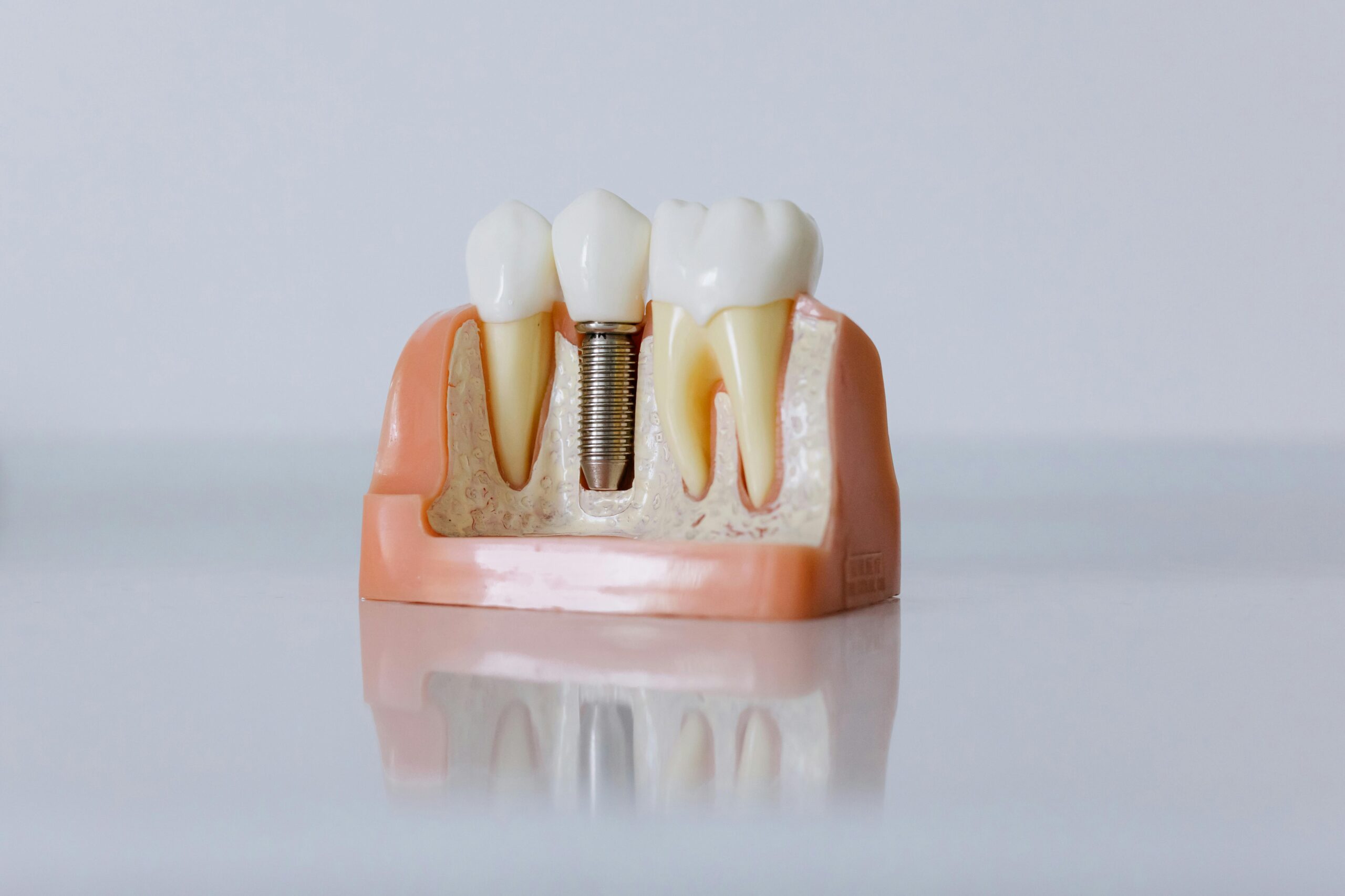 Dental Implants in Burnaby: A Highgate Dentist’s Complete Guide
